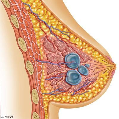 妇科炎症会引起乳房胀痛吗 妇科炎症的几个具体剖析